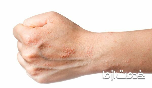 شناخت بیماری لیکن پلان دهانی و مویی؛ به همراه دلایل ایجاد لیکن پلان