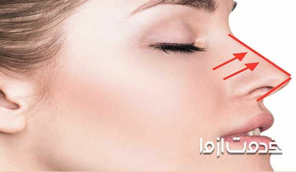 آموزش کامل نحوه چسب زدن بینی پس از جراحی