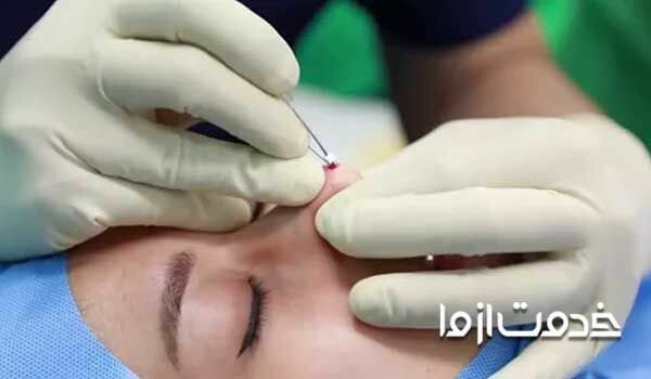 تغییر شکل بینی بدون جراحی