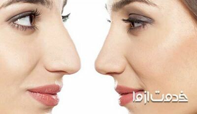 عمل بینی استخوانی طبیعی و هزینه آن