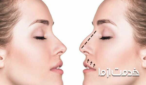 هزینه عمل بینی اقساط هزینه عمل بینی در تبریز هزینه عمل بینی در بیمارستان دولتی هزینه عمل بینی در شیراز 98
